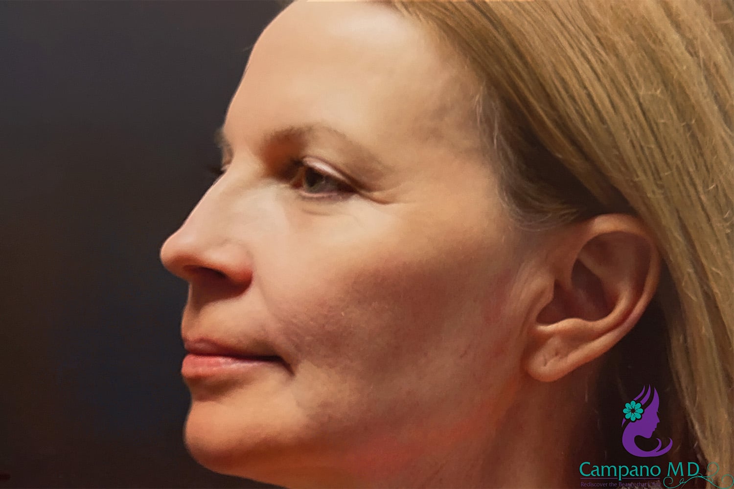 After Image: CO2 Laser Resurfacing - left-side