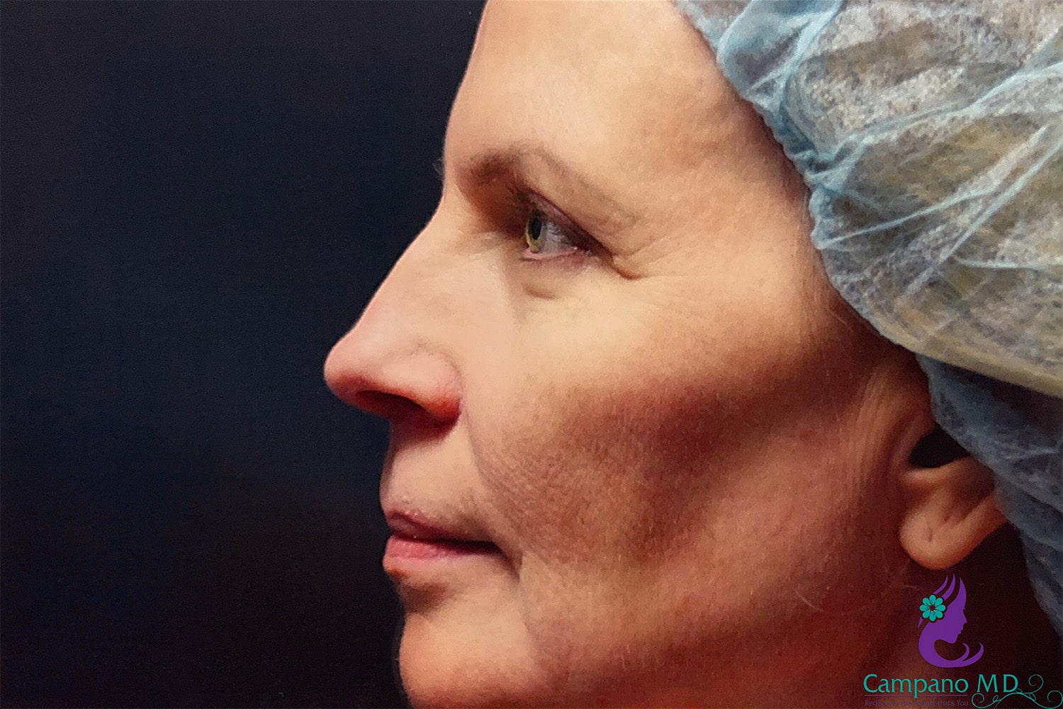 Before Image: CO2 Laser Resurfacing - left-side