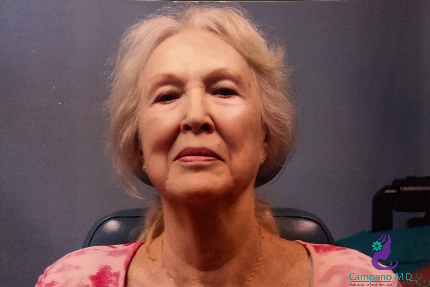 After Image: CO2 Laser Resurfacing - front