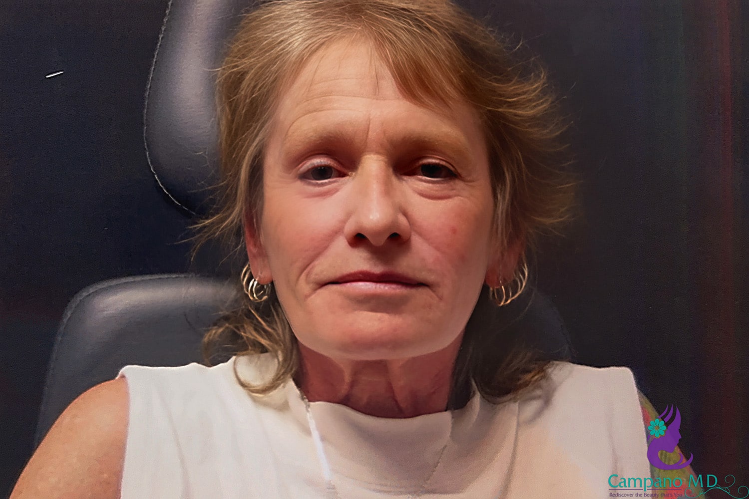 After Image: CO2 Laser Resurfacing - front