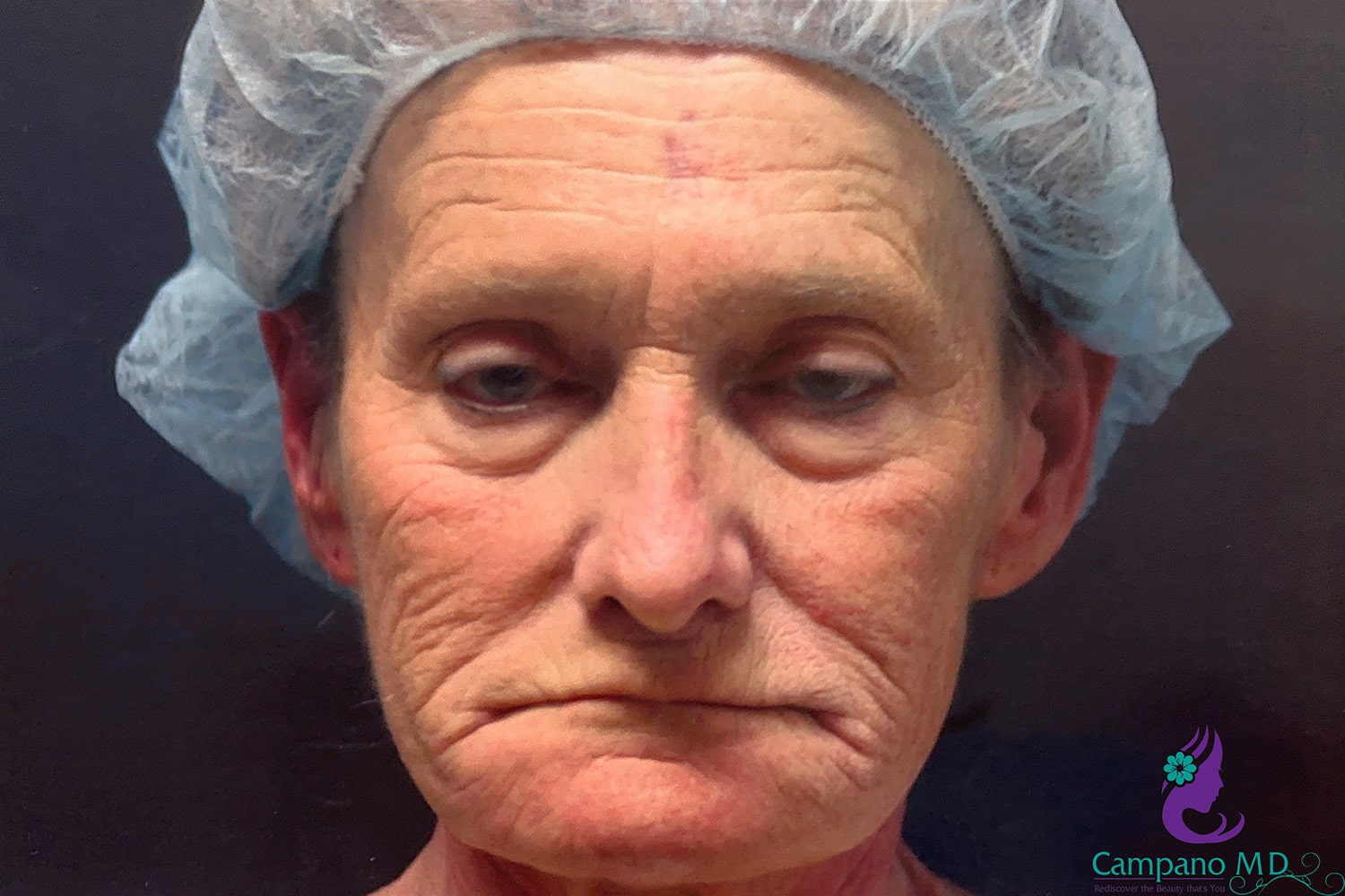 Before Image: CO2 Laser Resurfacing - front