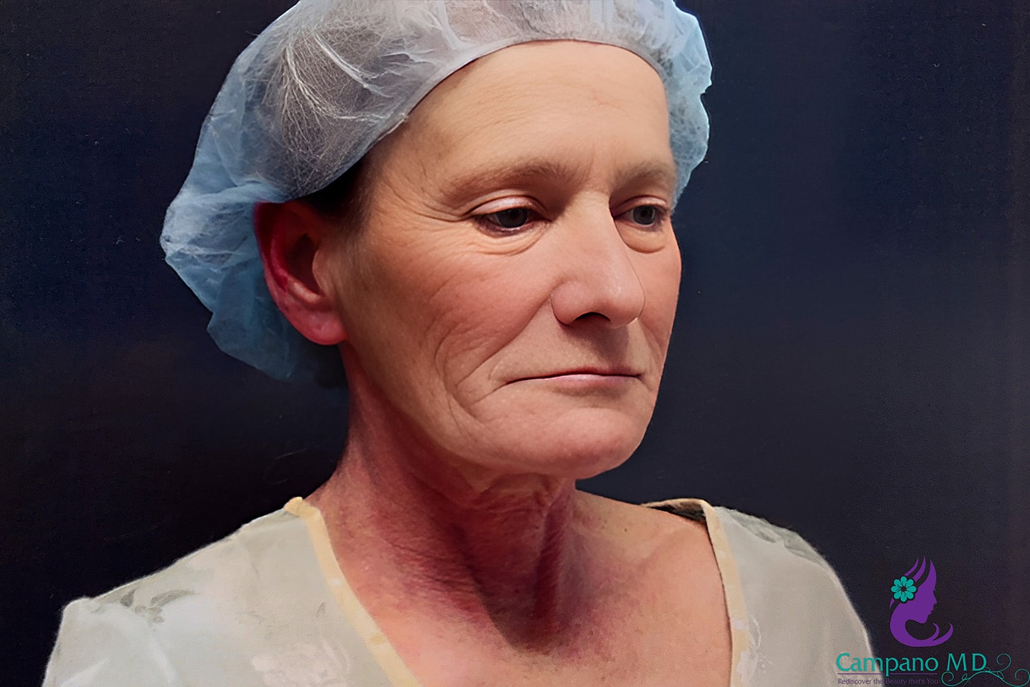Before Image: CO2 Laser Resurfacing - right-front-oblique