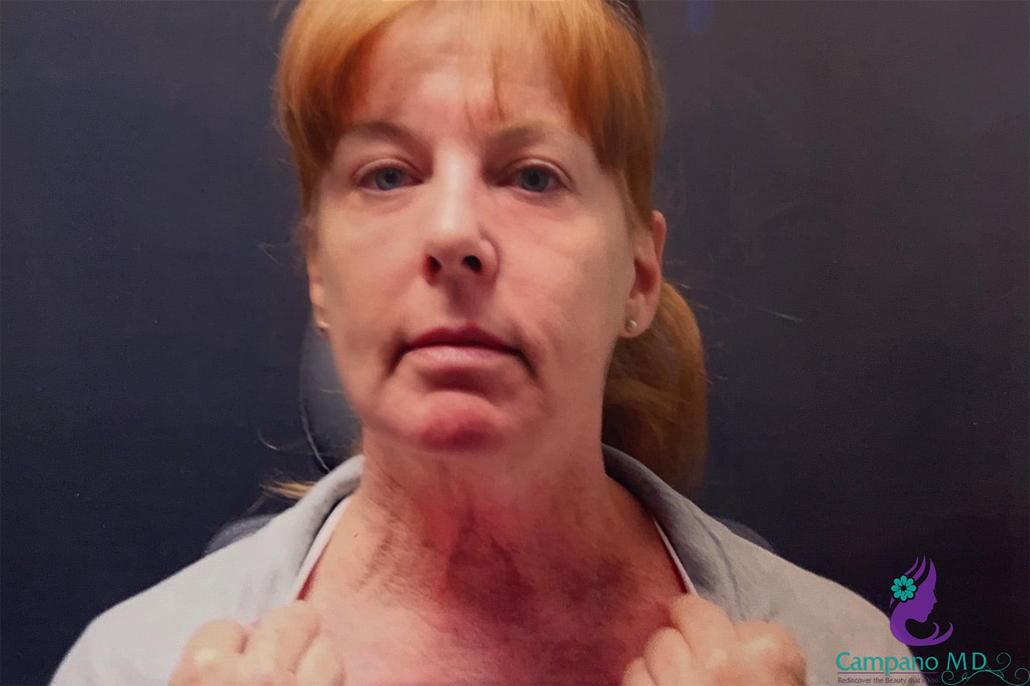 After Image: CO2 Laser Resurfacing