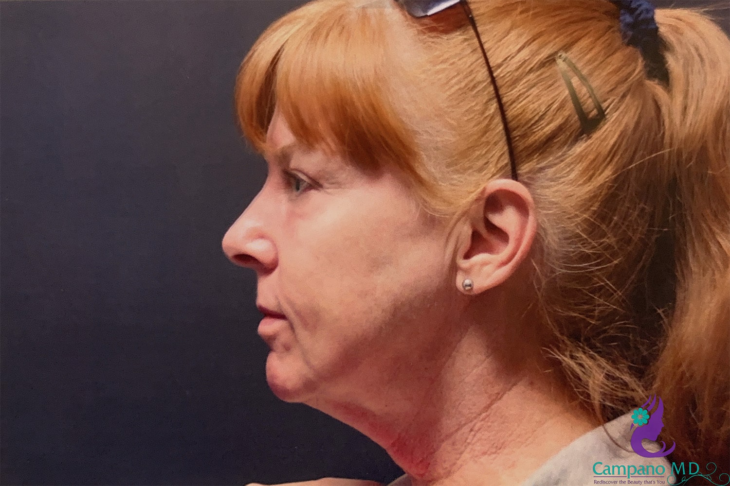 After Image: CO2 Laser Resurfacing - left-side