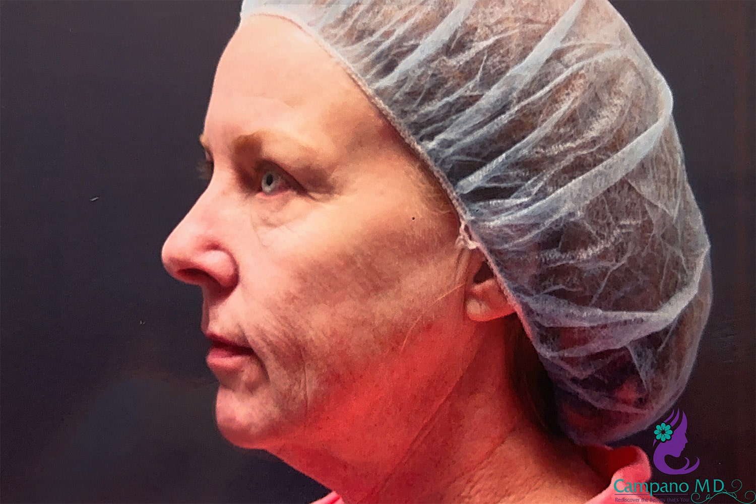 Before Image: CO2 Laser Resurfacing - left-side