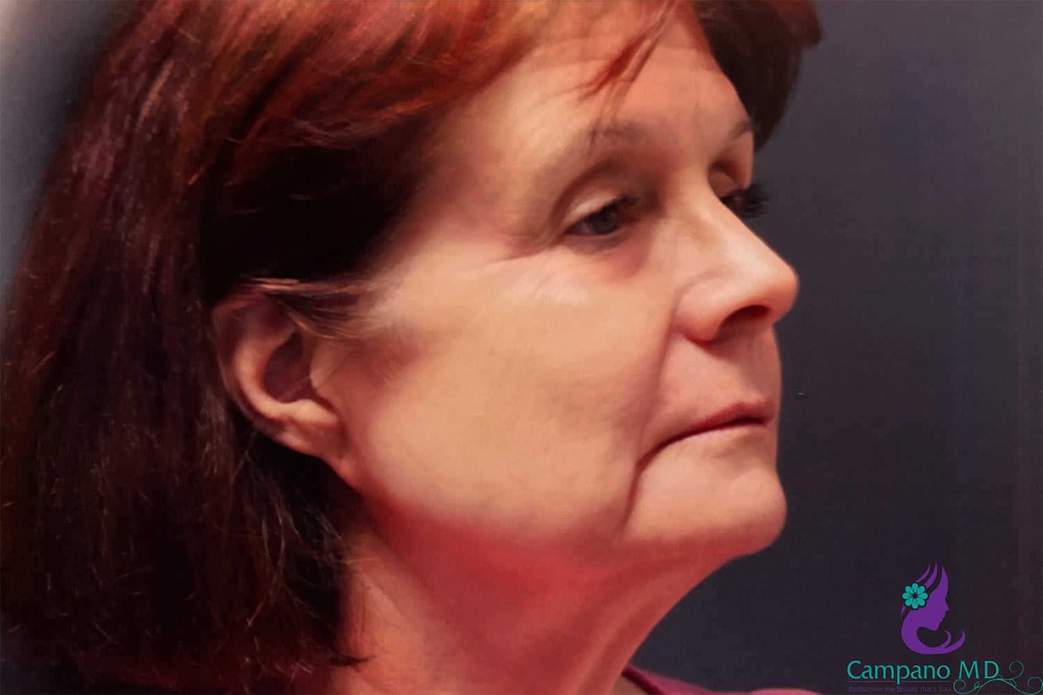 After Image: CO2 Laser Resurfacing - right-side