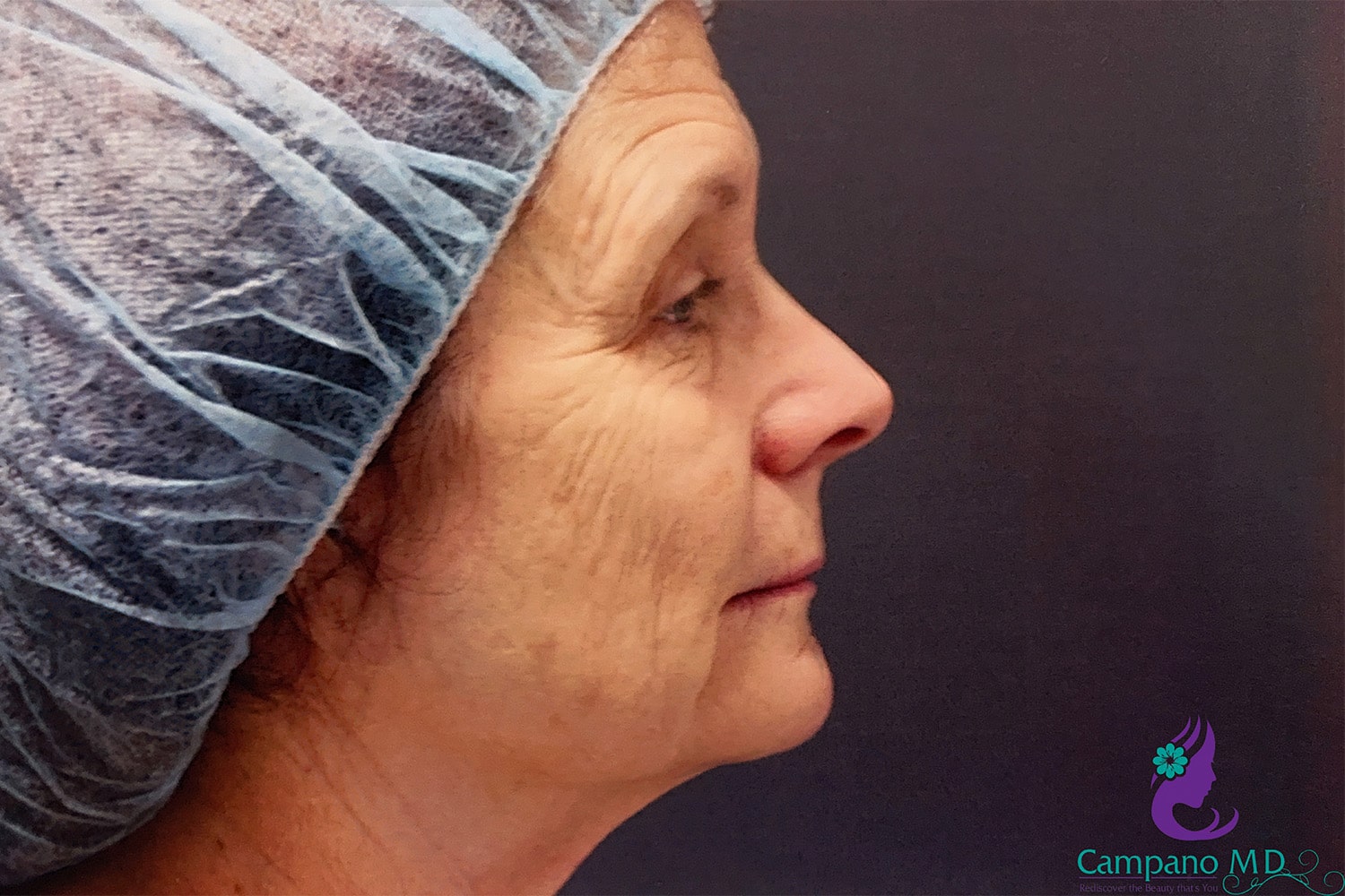 Before Image: CO2 Laser Resurfacing - right-side