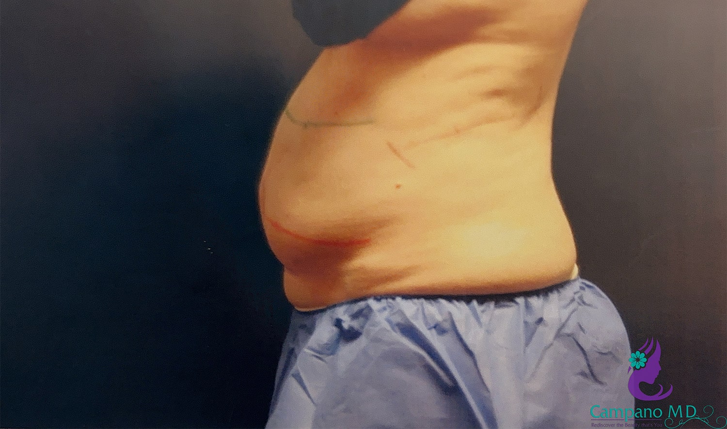 Before Image: CoolSculpting - left-side